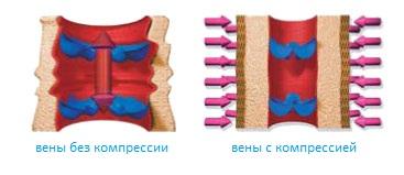 Компрессионная терапия