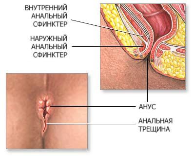 Анальная трещина
